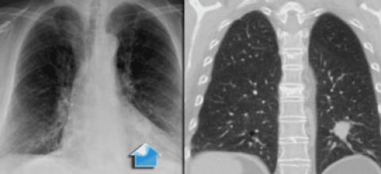 Guz T1 - typowy guz T1 w dolnym płacie płuca lewego, otoczony całkowicie przez miąższ płucny.