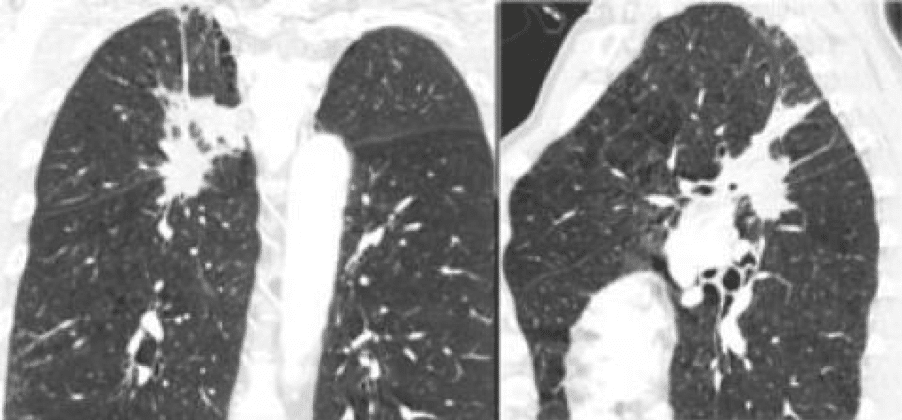 Rak płuca z wyraźnie widocznym wzrostem przezszczelinowym w rekonstrukcji wieńcowej i strzałkowej; lobektomia nie jest już w tym wypadku możliwa.