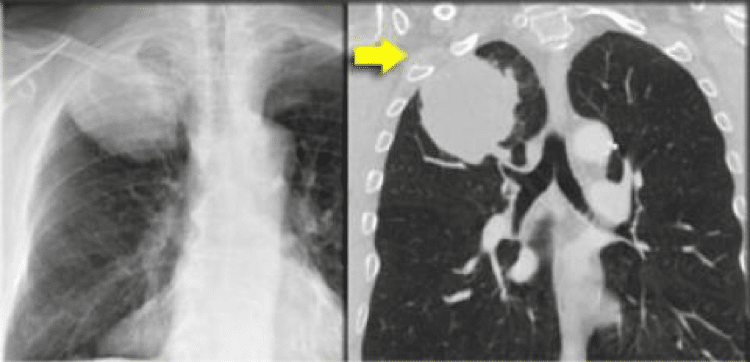 Guz T3 - typowy guz T3 w górnym płacie płuca prawego naciekający ścianę klatki piersiowej 